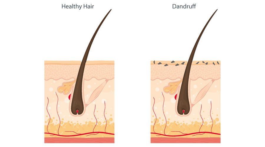 dandruff causes