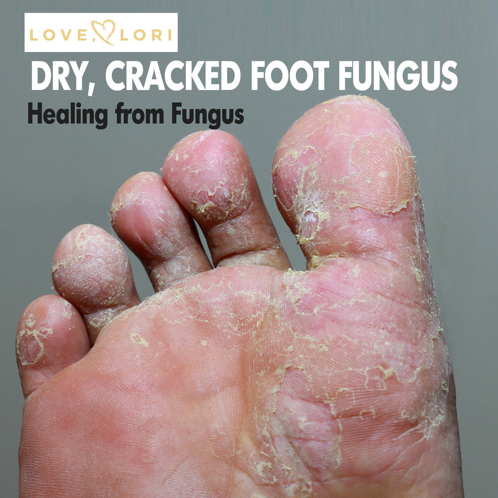 dry crusty feet