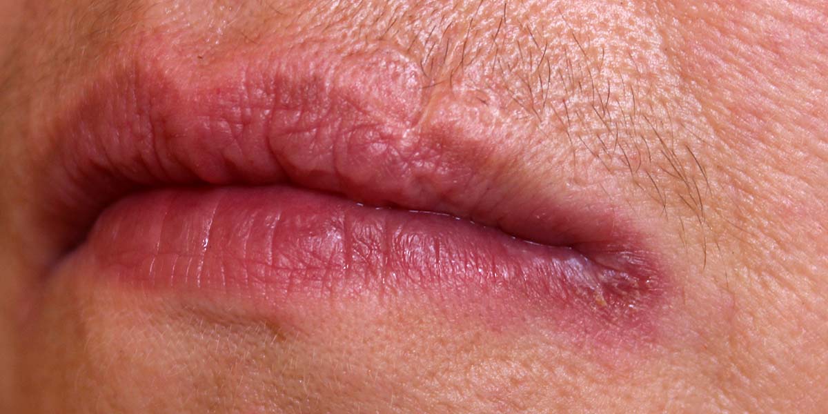 Skin Conditions on and Around Mouth –