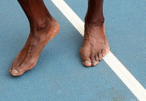 Usain Bolt’s feet. Years of intense running in shoes.