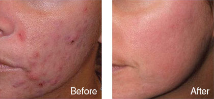 before and after acne scar treatment derma roller system image