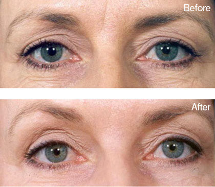before and after eye bag treatment derma roller system image