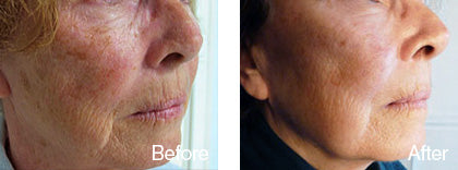 before and after skin smoothening treatment 2 derma roller system image