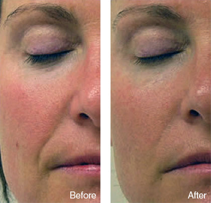 before and after skin smoothening treatment derma roller system image