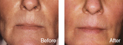 before and after skin smoothening treatment 3 derma roller system image