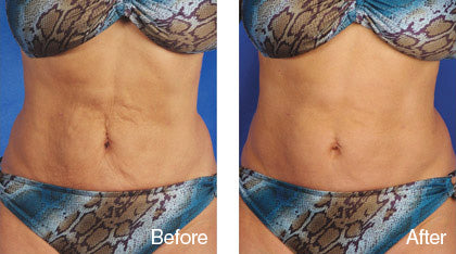 before and after stretch mark treatment derma roller system image