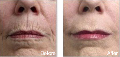 before and after nose skin smoothening treatment derma roller system image