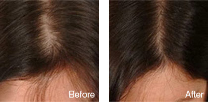 before and after hair regrowth treatment for women derma roller system image