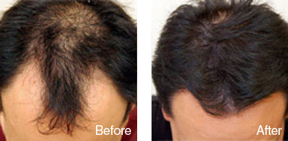before and after hair regrowth treatment for men derma roller system image