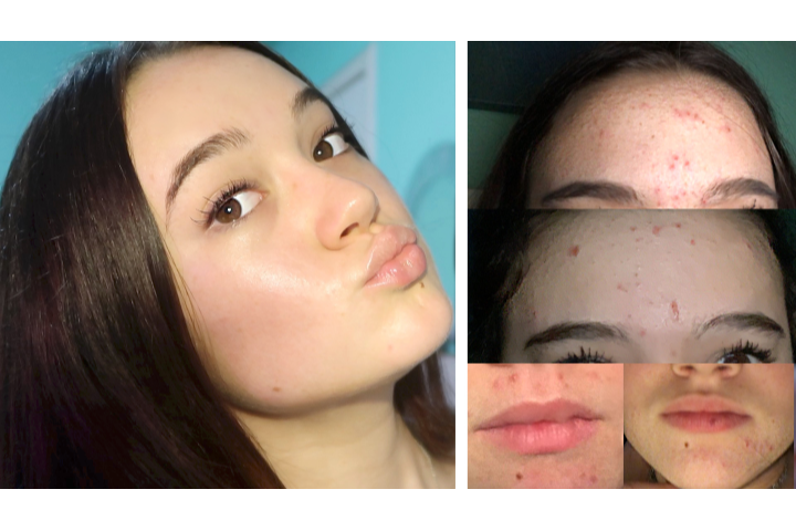 Acne to Clear Skin My Everyday Skincare Rout