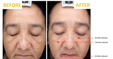 Nigella Therapy Clinical Study: Before After photo sample showing reduction in wrinkles.