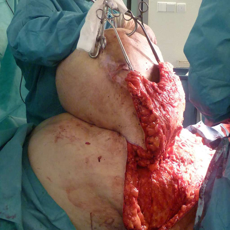 Abdominoplasty