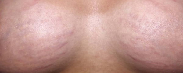 Breast stretch marks