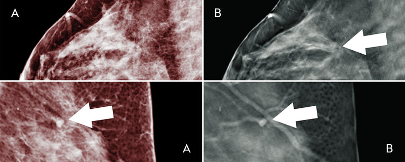 Dense Breast Cancer Screening