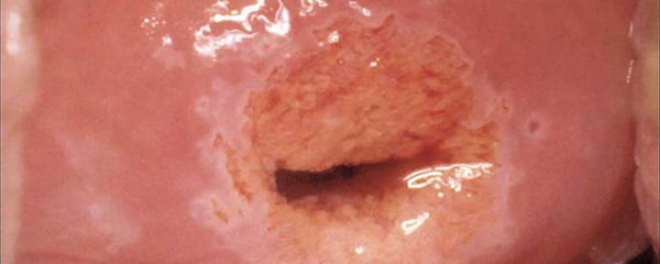 Normal cervix