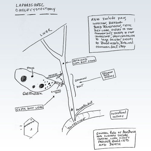 Laparo­scopic Cholecys­tectomy Cartoon