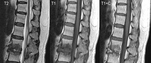 Pyogenic spondylitis MRI