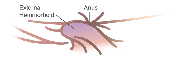 External Hemorrhoid