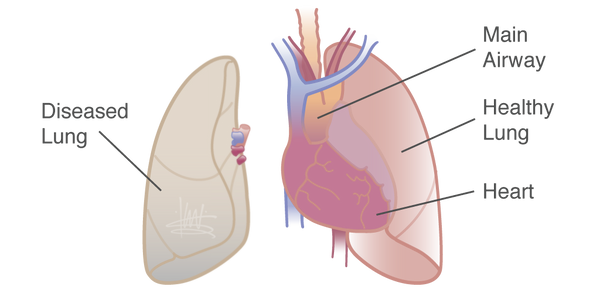 Lung transplant