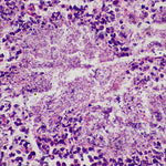 Pulmonary Candidiasis