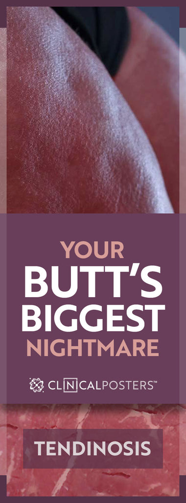 Your Butt May Be Literally Tearing Apart