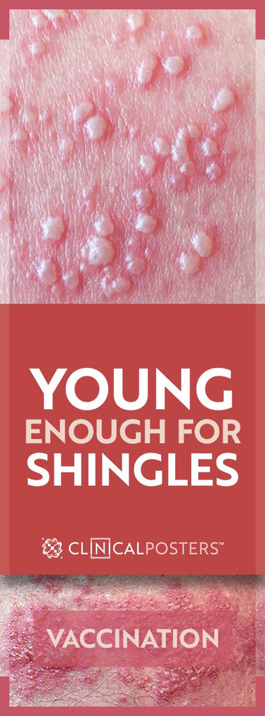 Shingles herpes zoster symptoms