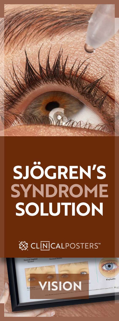 Sjögren’s Syndrome: Pain Beyond Tears