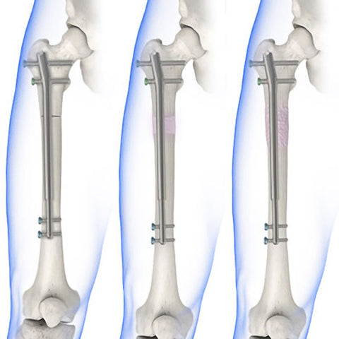 Precise Intramedullary Limb Lengthening System