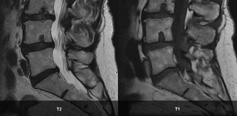 Schmorl Nodes MRI