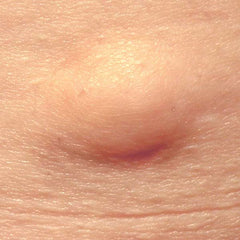 Lipoma