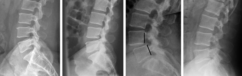 Spine variance