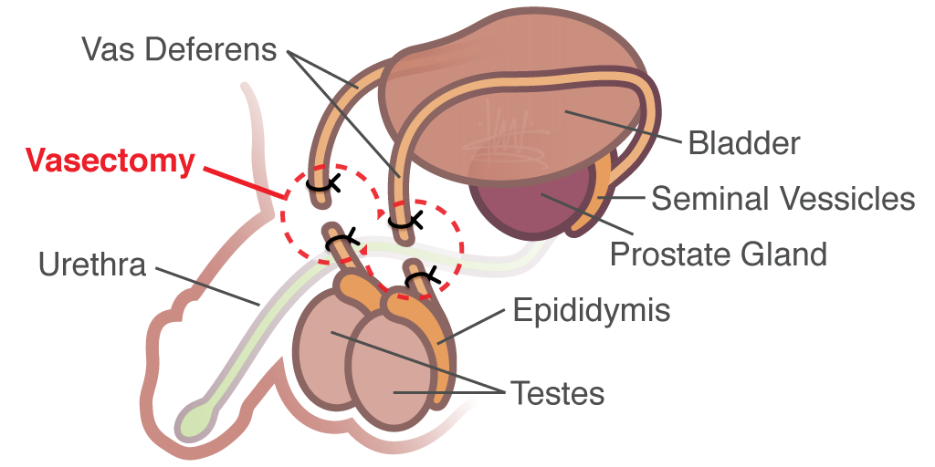 Vasectomy diagram