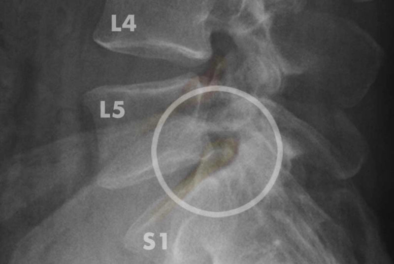 L-4 through S1 vertebrae x-ray