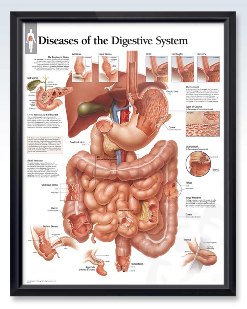 Diseases of the Digestive System ExamRoom Anatomy Poster ClinicalPosters