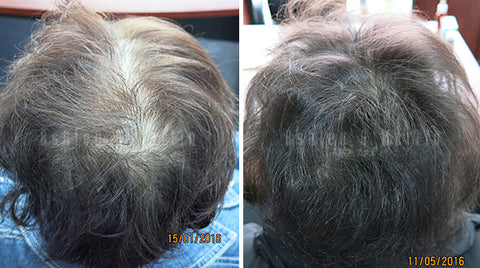 before and after of using low level laser therapy cap