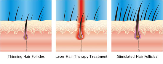 laser hair therapy treatment