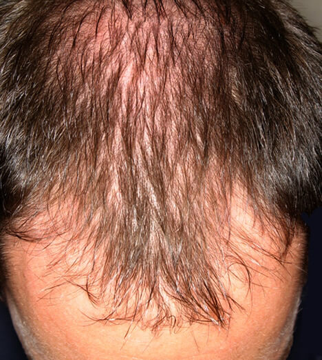 why hair loss