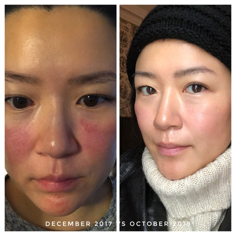 Iremia Before and After Rosacea Flare Up