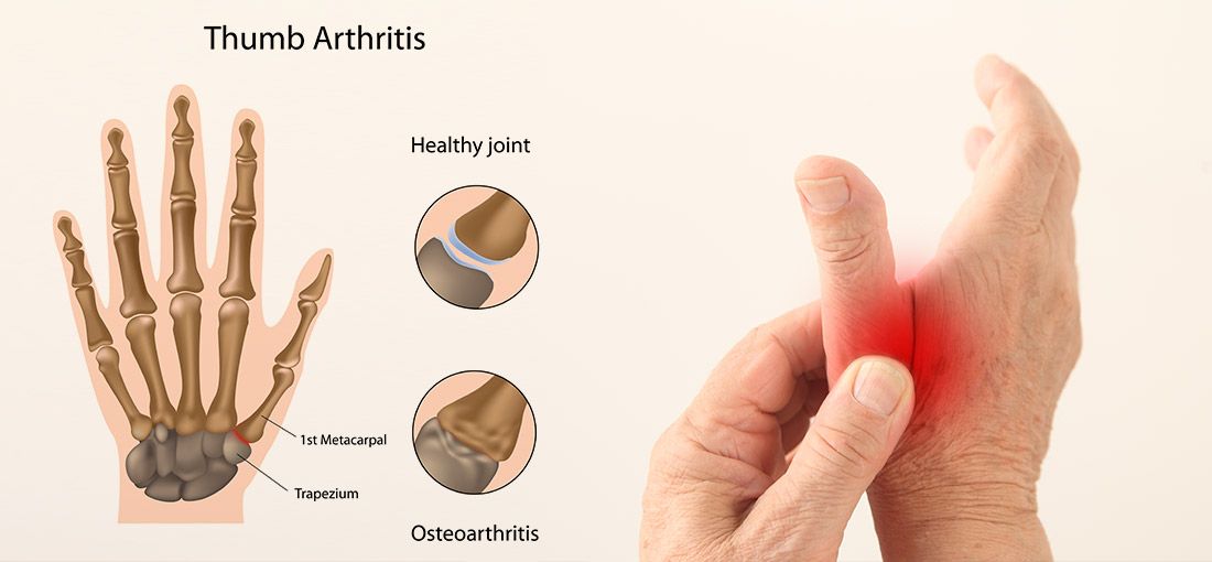 home-remedies-just-jammed-your-finger-jammed-finger-finger-injury