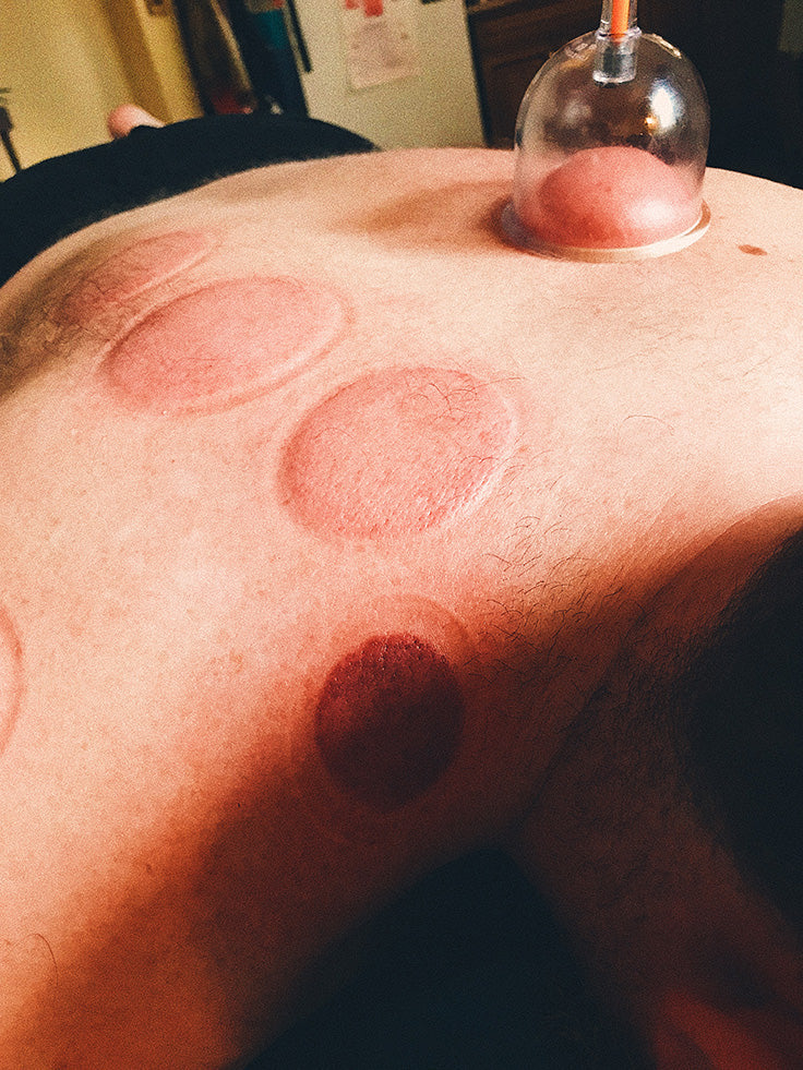 Ned CBD Cupping Therapy Benefits