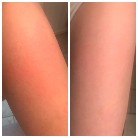 Alni Body Care CBD Salve for Food Allergy Skin Rash.  Red, Itchy Skin.  Skin Rash Relief.  Before and After. 