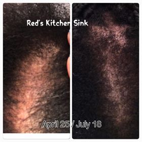 Results  Three Months after using Beaucoup Hair Herbal Hair System Lite
