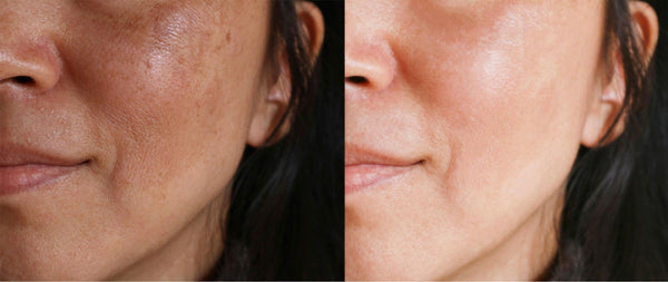 Skin Lightening Natural Organic Pigmentation Removal Hyperpigmentation Singapore