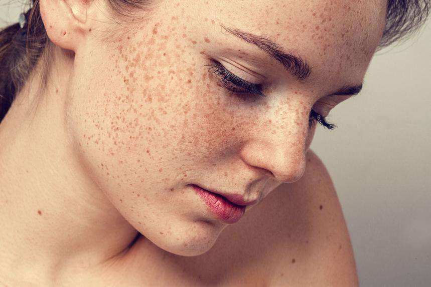 5 Ways To Fight Sun Spots And Hyperpigmentation | Babyface