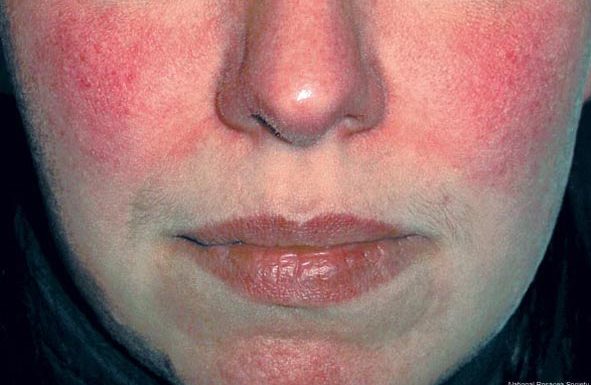 How To Cope With Rosacea