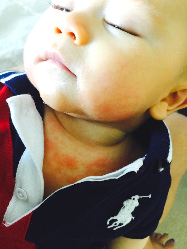 4 month old baby suffering from eczema