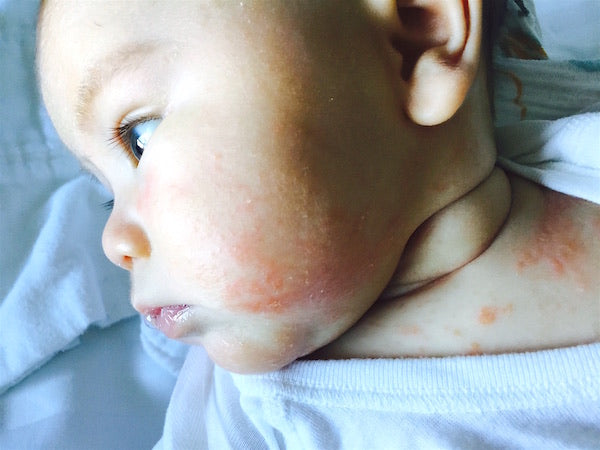 4 months old baby with eczema