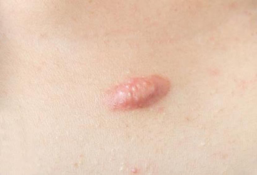 A keloid acne scar