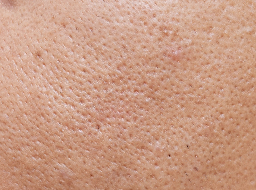 A closeup photo of skin showing enlarged pores