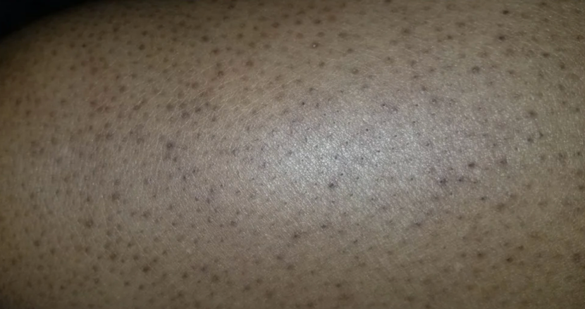 A closeup of keratin bumps from keratosis pilaris